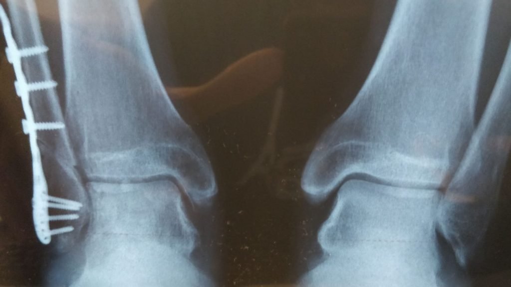 X-ray pergelangan kaki David